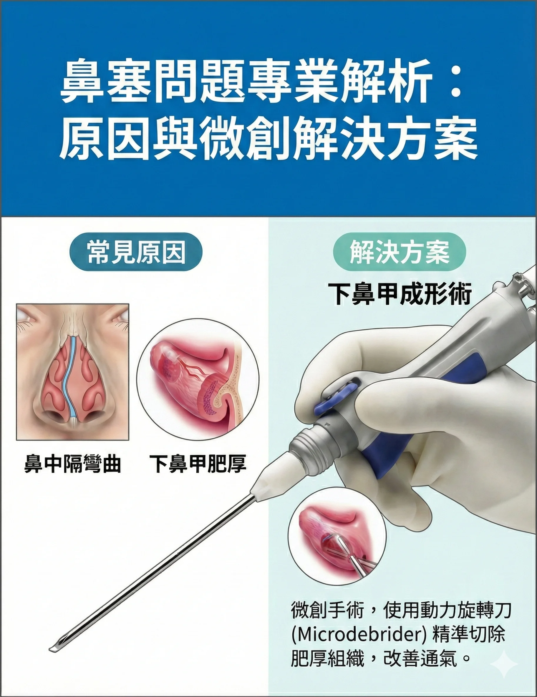 下鼻甲成形術 — 微創動力旋轉刀 Microdebrider 精準切除肥厚組織、改善通氣
